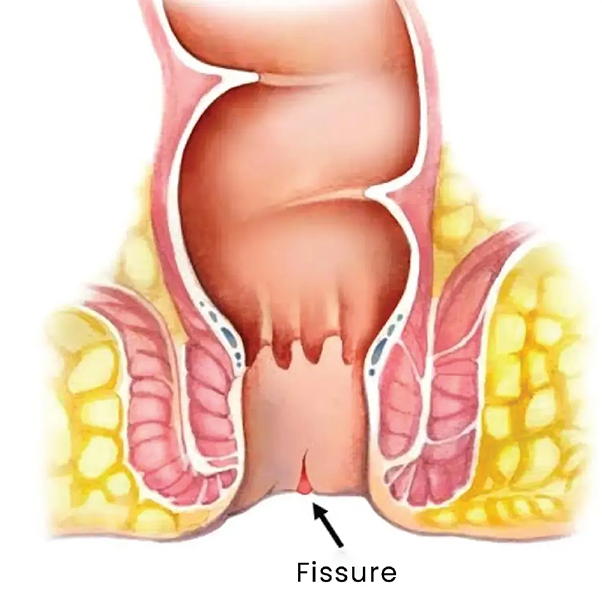 Anal Fissure