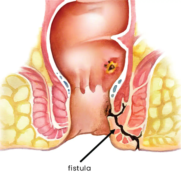 Anal Fistula