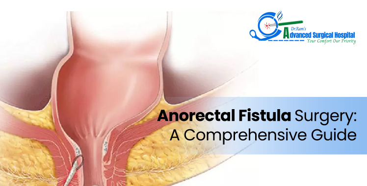 Anorectal Fistula Surgery: A Comprehensive Guide