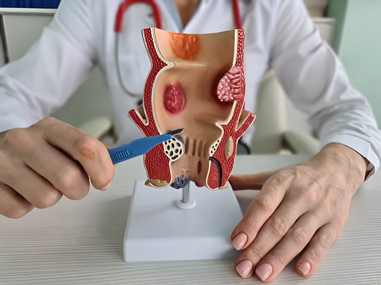 Symptoms of Pilonidal Sinus