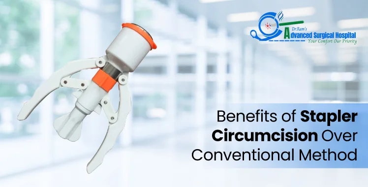 Benefits of Stapler Circumcision Over Conventional Method