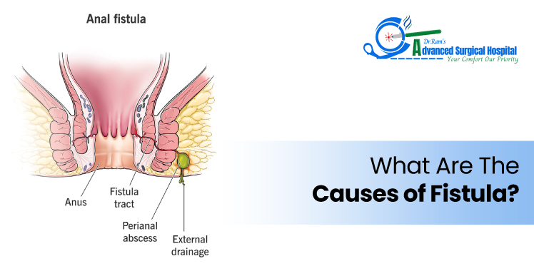 Stages of Fissure Healing Stages of Fissure Healing