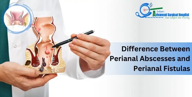 Difference Between Perianal Abscesses and Perianal Fistulas Difference Between Perianal Abscesses and Perianal Fistulas