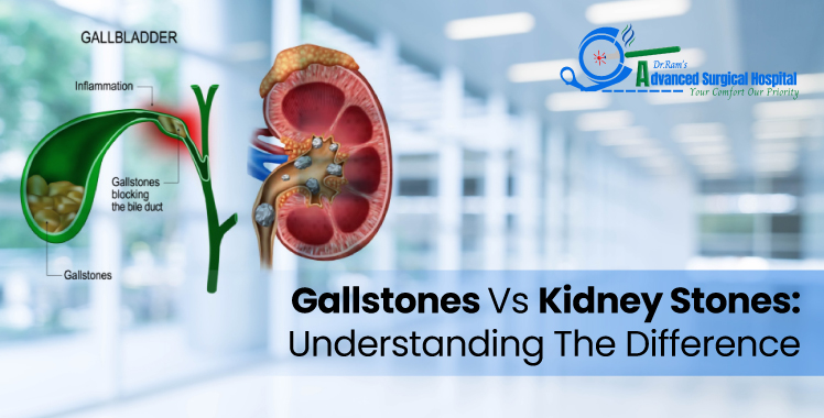 Gallstones Vs Kidney Stones
