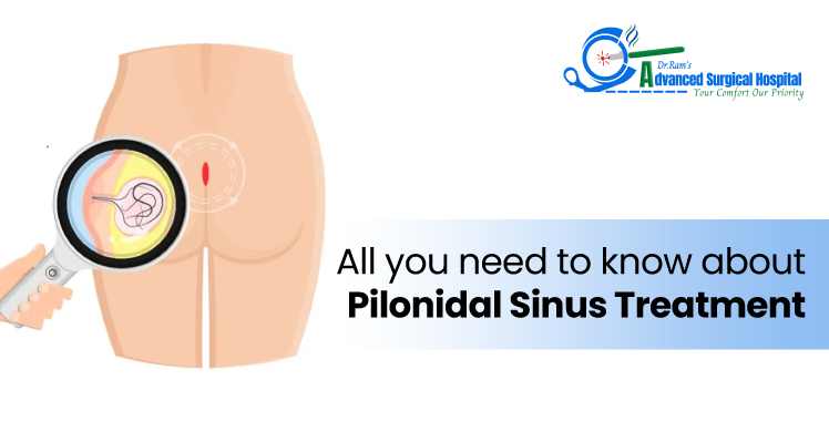 pilonidal sinus treatment