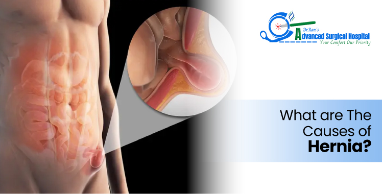 What are The Causes of a Hernia?
