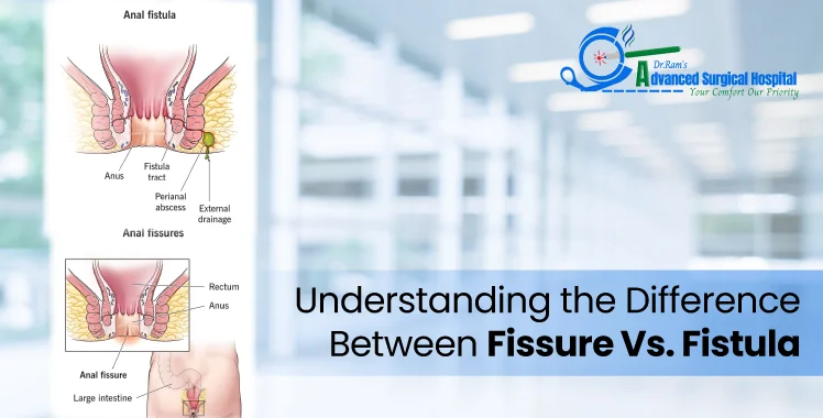 Understanding the Difference Between Anal Fissure Vs. Fistula