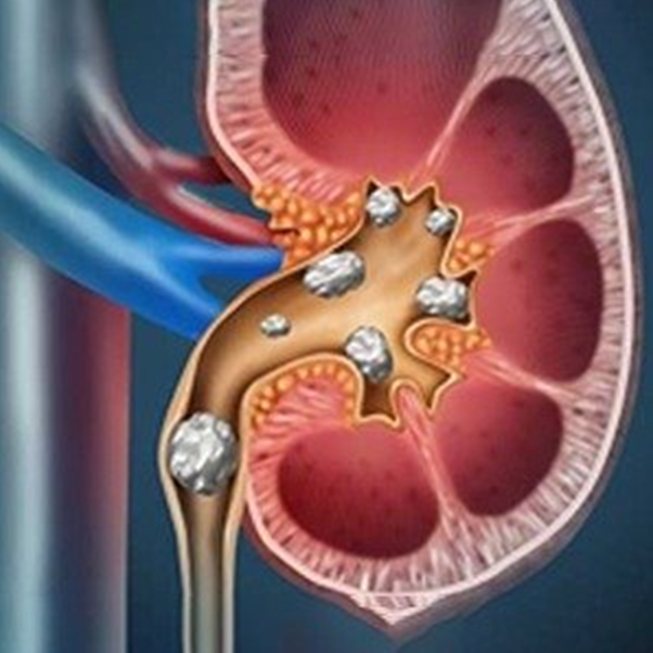 Kidney Stone