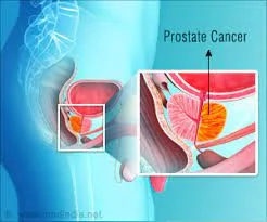 Prostate Surgery in Ahmedabad