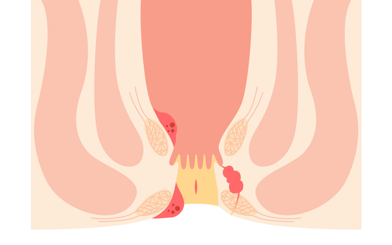 Laser Piles Treatment in Ahmedabad Laser Piles Treatment in Ahmedabad