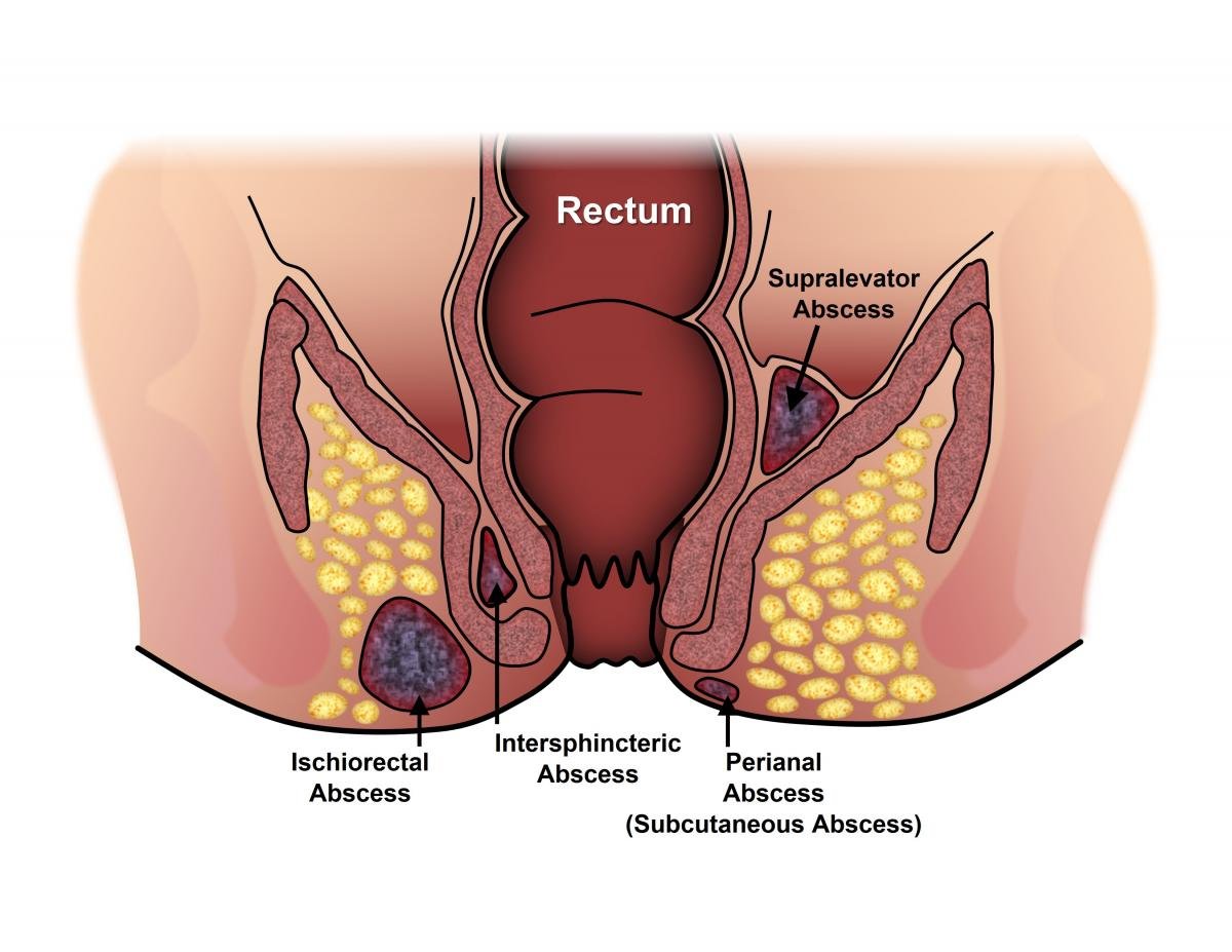 Fistula Tretment Fistula Tretment