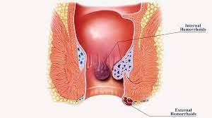 Laser Haemorrhoidopexy Laser Haemorrhoidopexy