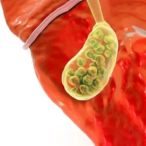 Gallbladder Stone Treatment in Ahmedabad