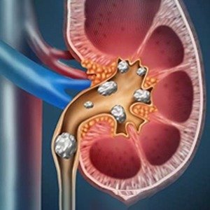 Kidney Stone