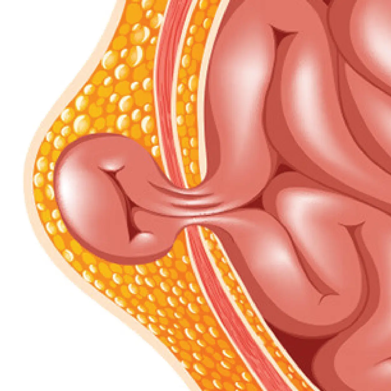 Hernia Treatment in Ahmedabad