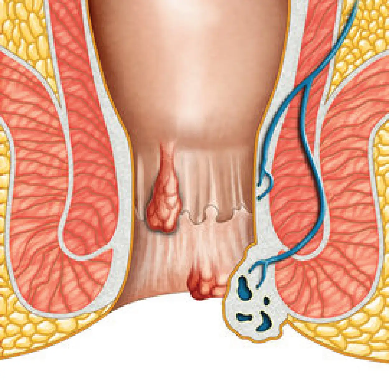 Piles Treatment in Ahmedabad