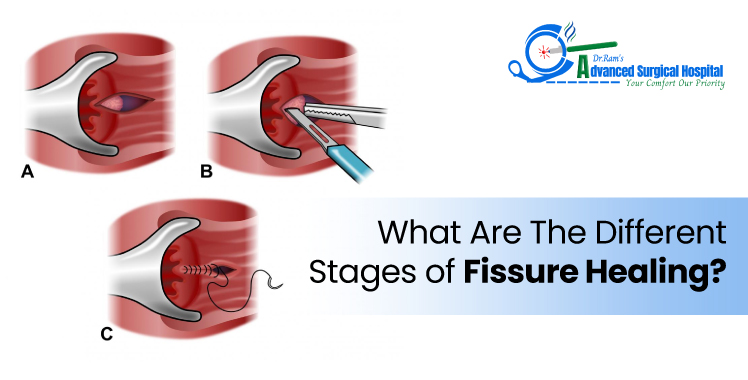 What are the Different Stages of Fissure Healing?