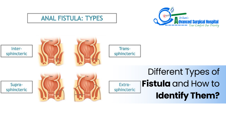 Different Types of Fistula and How to Identify Them
