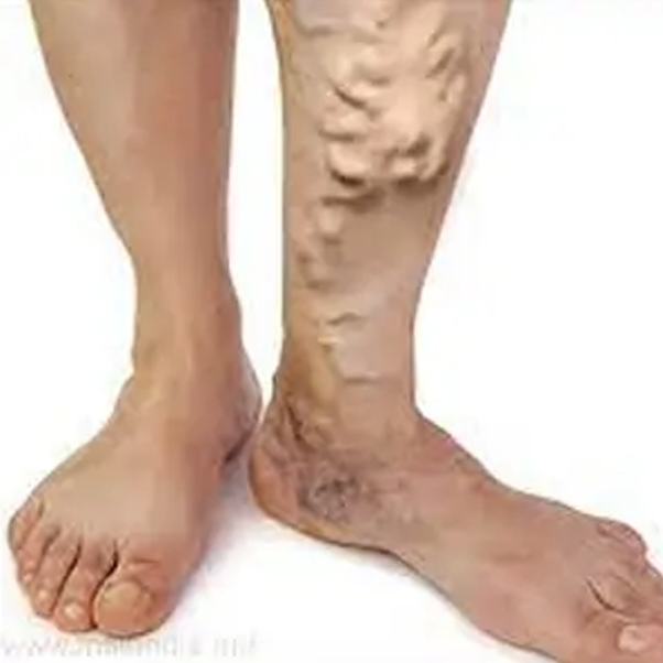 Varicose Viens