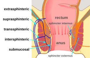 Types of Fistula