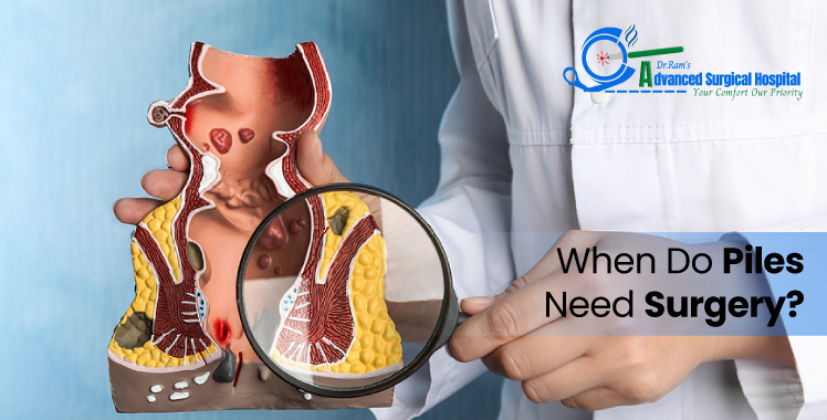 When Do Piles Need Surgery?